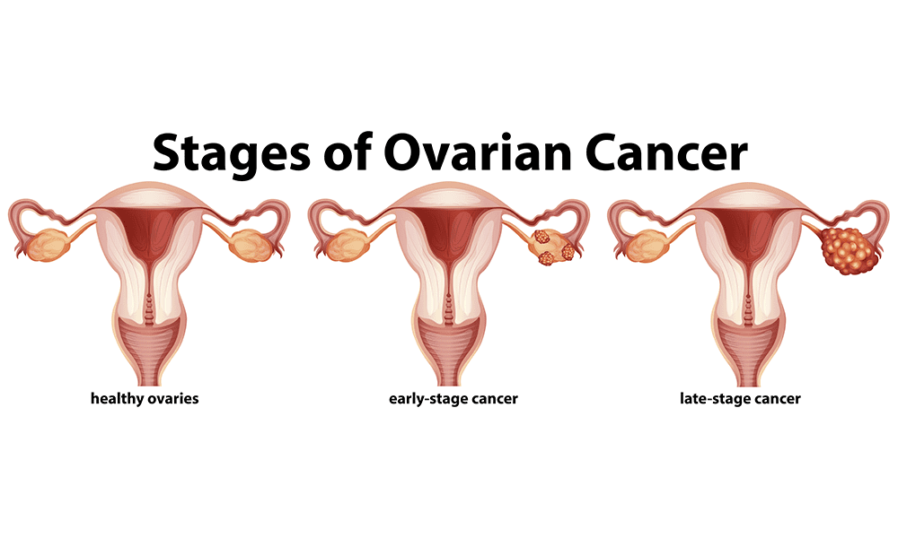 Check For Ovarian Cancer At Home