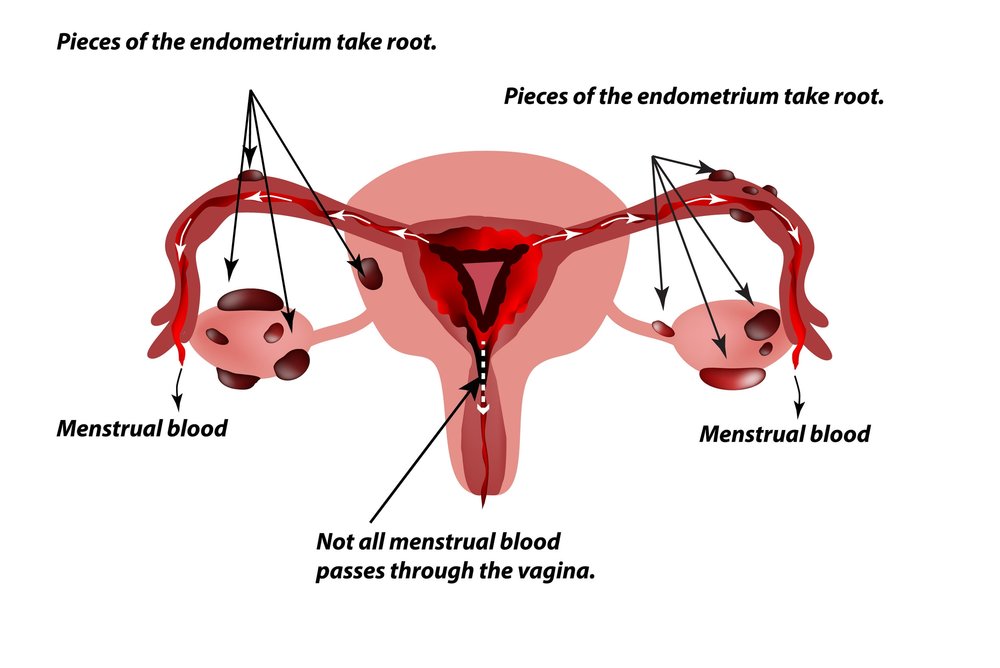 Understanding Endometriosis Causes Symptoms And Treatment Options Heyusanews